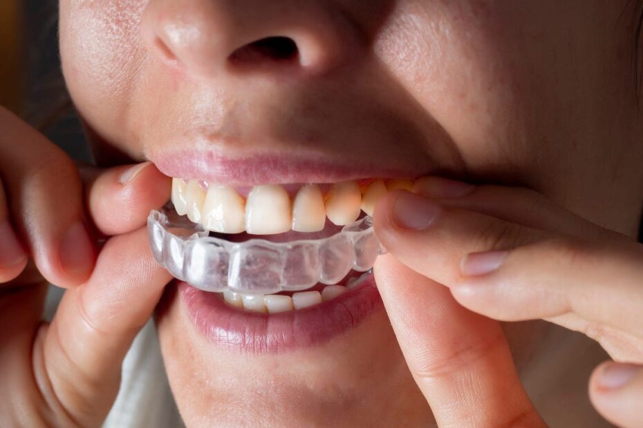 Comfort Covers for Braces